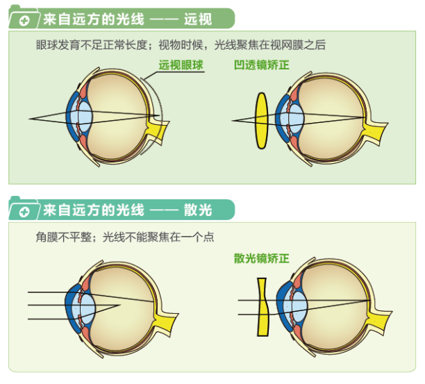 【圖文詳解】帶您“看透”近視遠視及散光