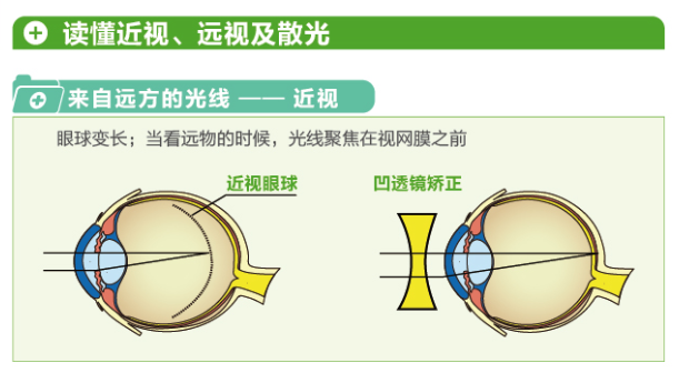 【看圖解】一張圖教你看懂近視、遠(yuǎn)視和散光