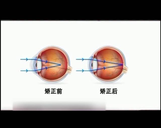 一夜之間真的能改變視力嗎？