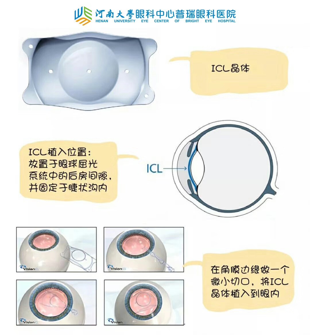 近視度數(shù)太高，還能做手術嗎？