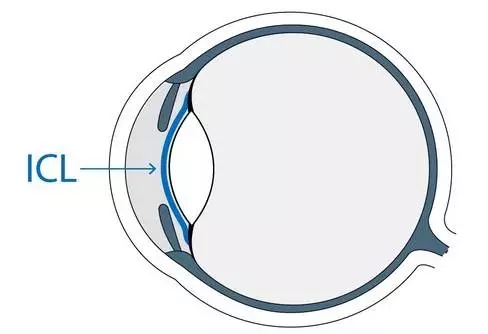想做ICL晶體植入術(shù)，你需要了解的全在這里!